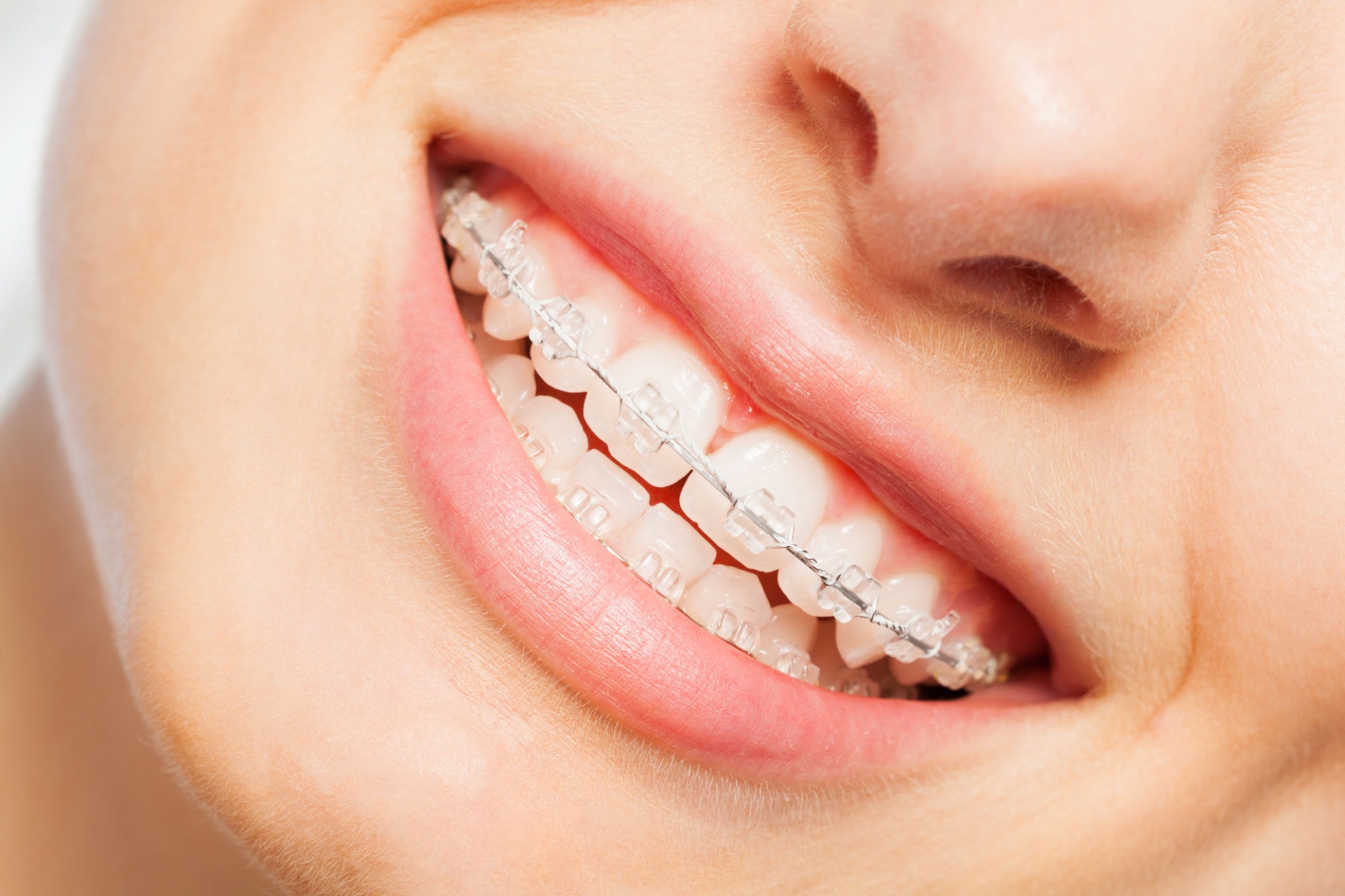 Clear (Ceramic) Braces